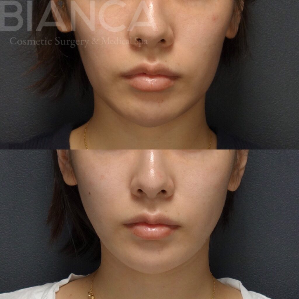 スレッドリフト