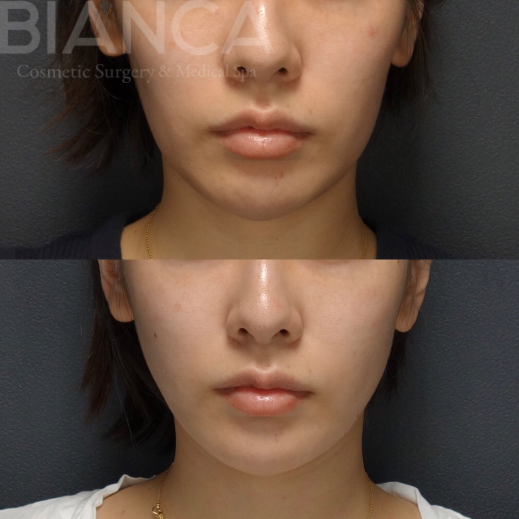 スレッドリフト