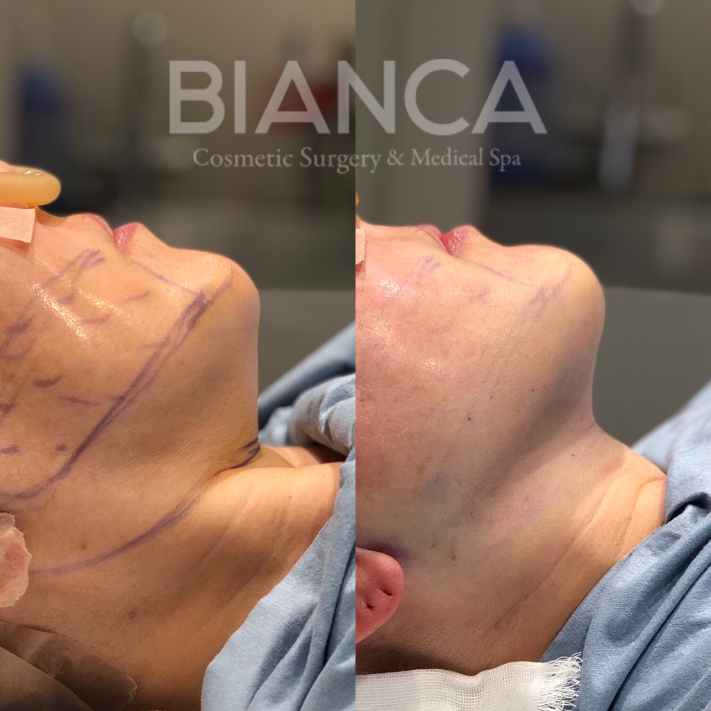 スレッドリフト・フェイスライン脂肪吸引