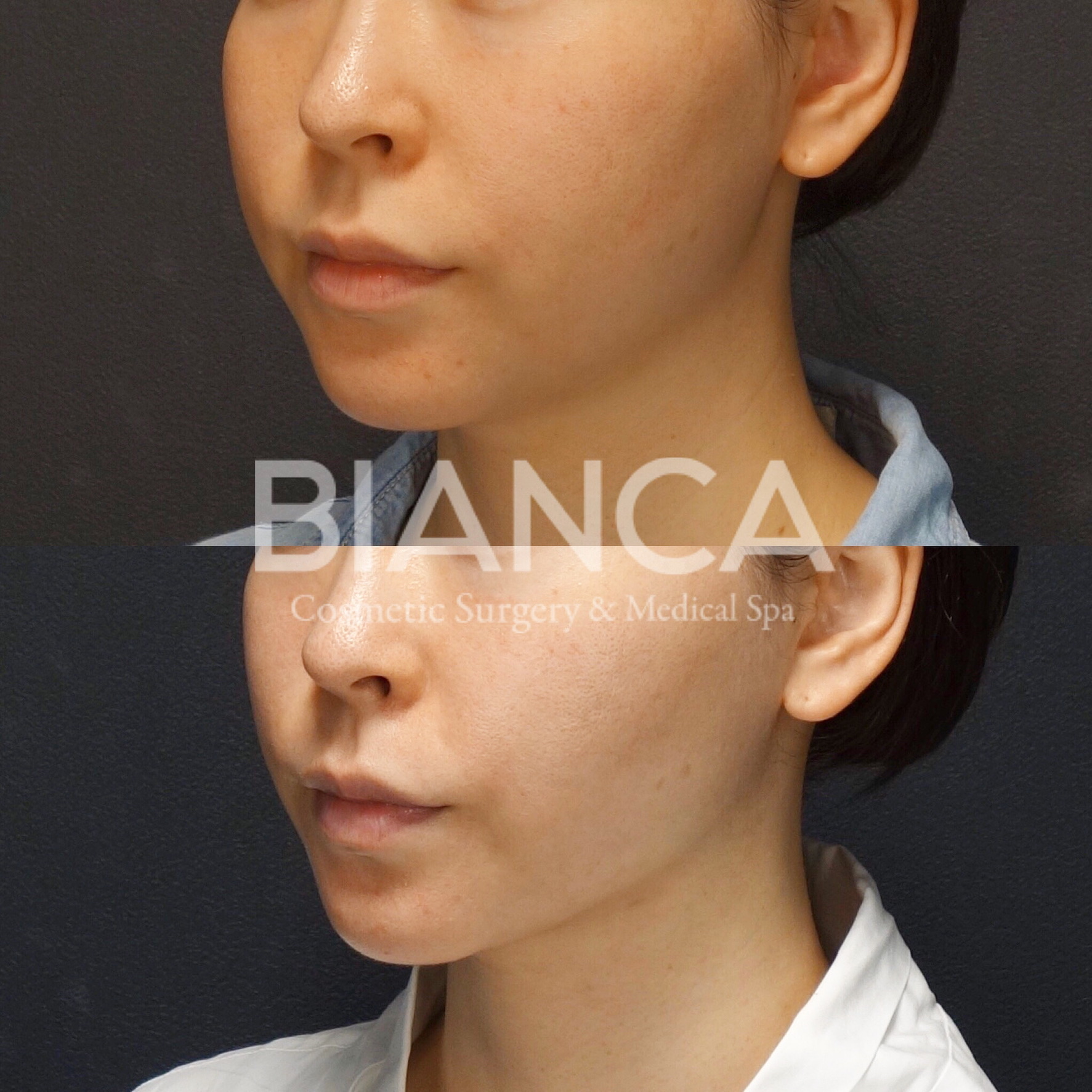 BIANCA LIFT＋バッカルファット＋フェイスライン脂肪吸引 