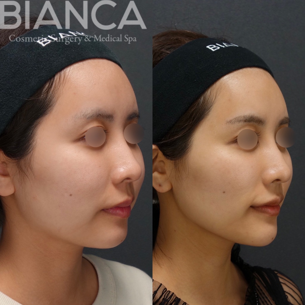 BIANCA LIFT＋MINT LIFT＋メーラーファット・フェイスライン脂肪吸引 ＋ヒアルロン酸