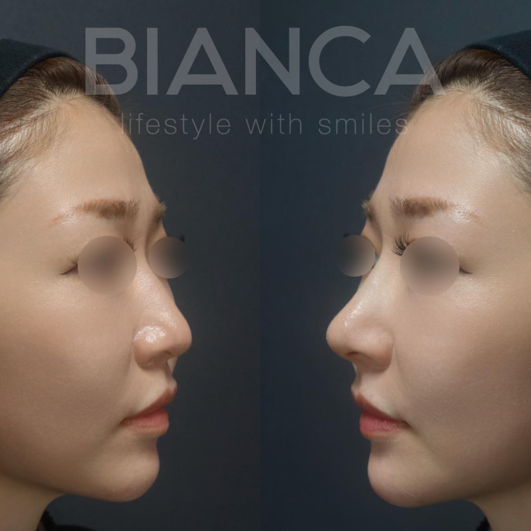 ヒアルロン酸注射（鼻）