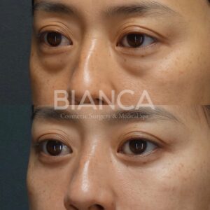 目の下クマたるみ取りでクマ改善した症例写真