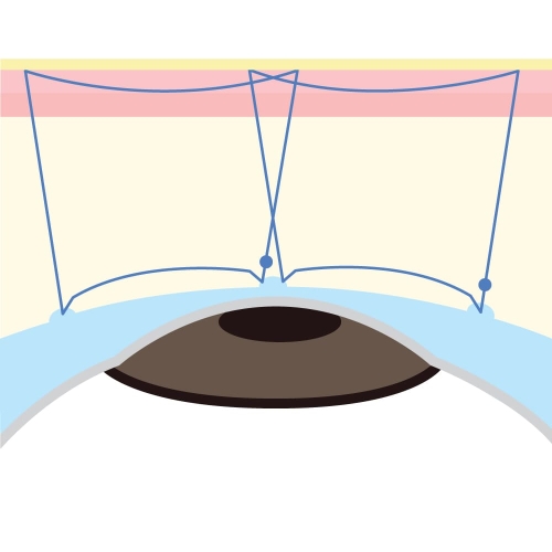 二重埋没法（裏留め）B TWICE