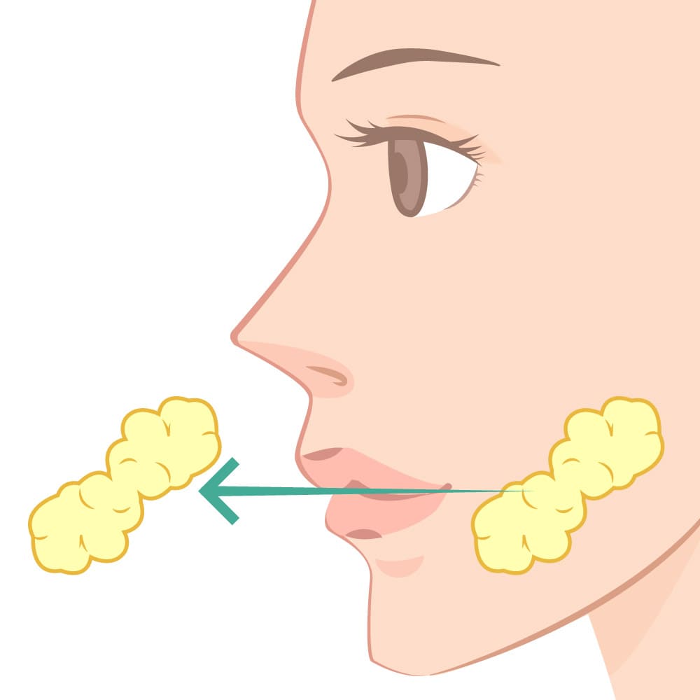 バッカルファット除去とは