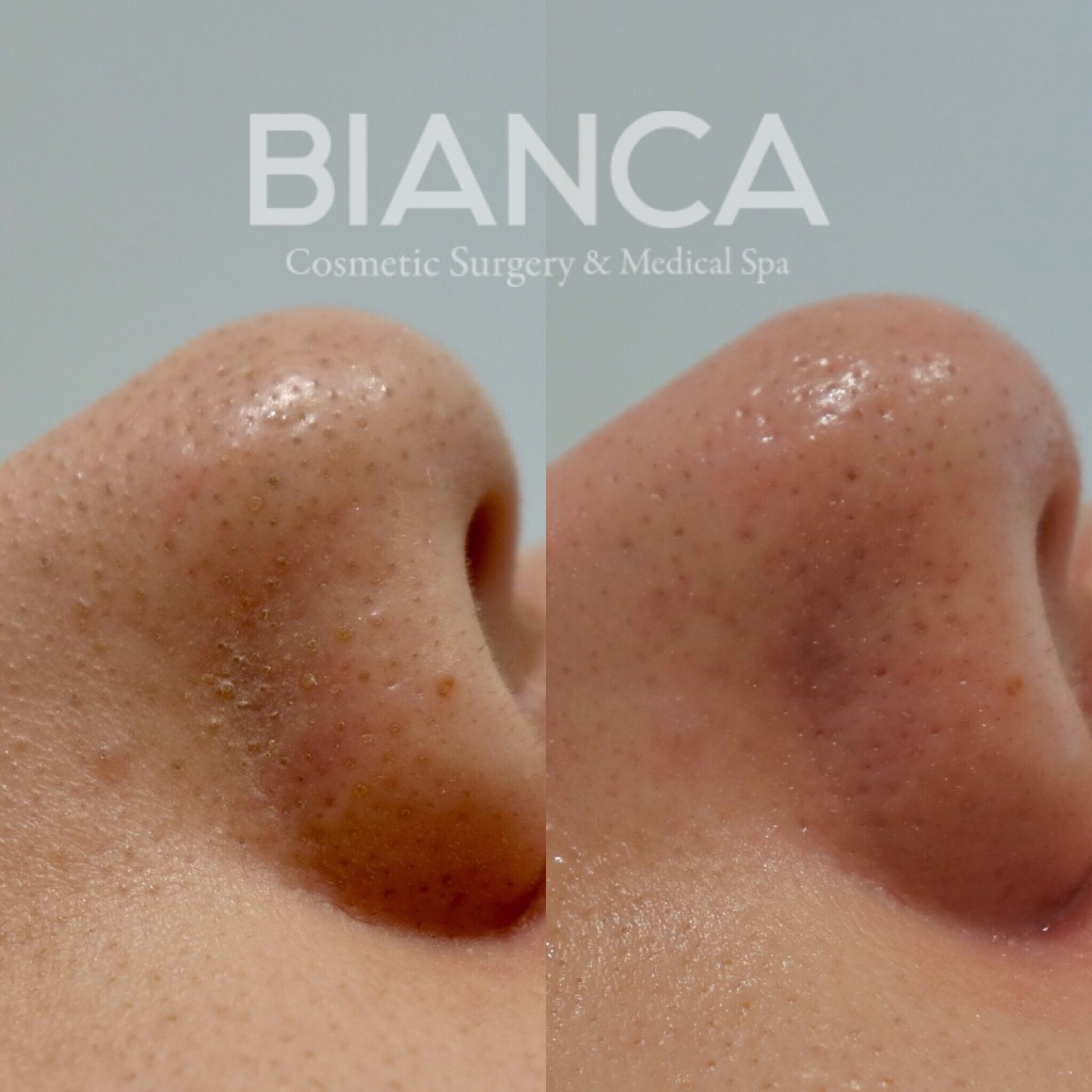 ハイドラフェイシャル（Hydrafacial）