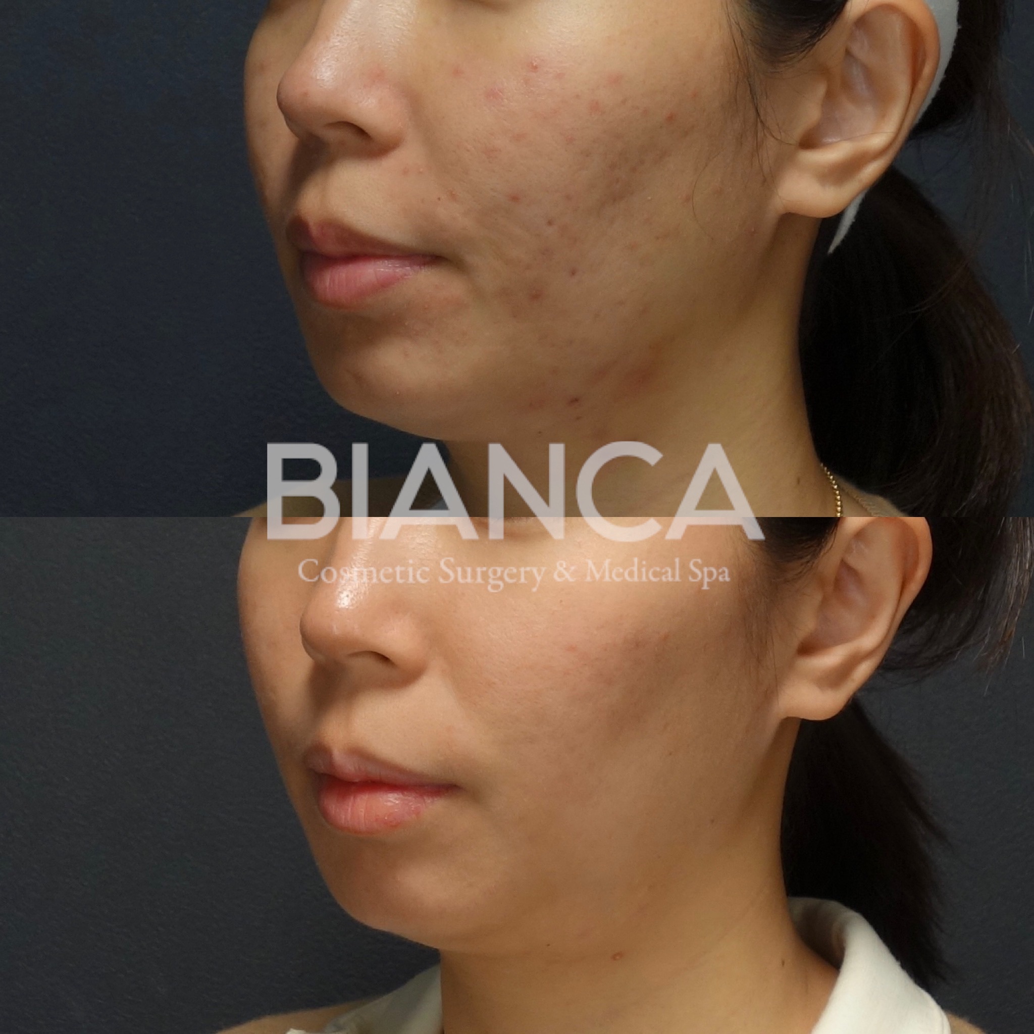 ハイドラフェイシャル（Hydrafacial）・ロアキュテイン（Roaccutane）