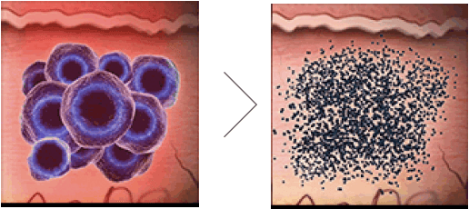 肌へのダメージや炎症後色素沈着のリスクが少ない