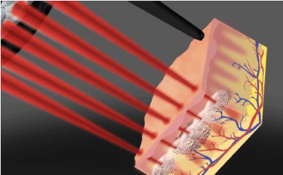 ピコフォーカス（ピコフラクショナル）とは
