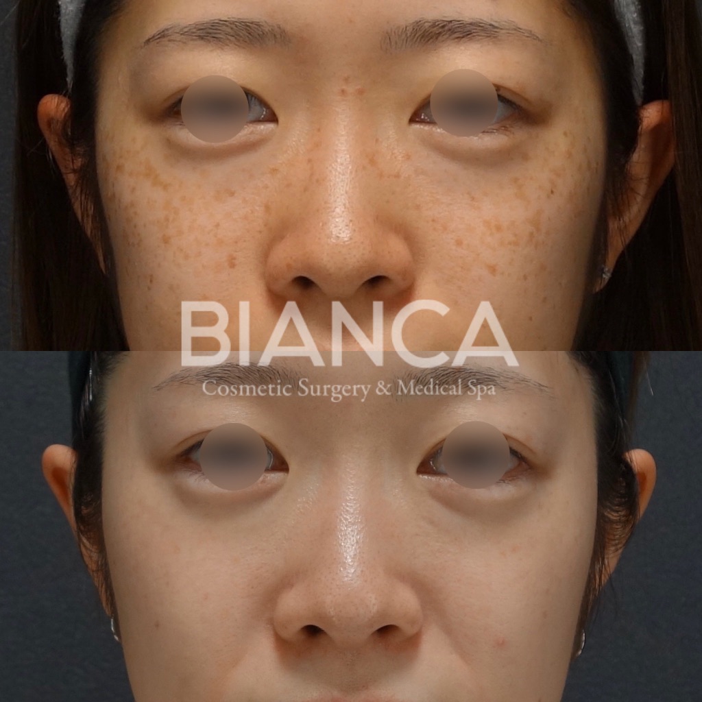 ピコトーニング（Pico Toning）