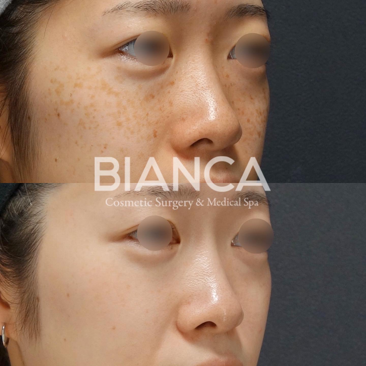 ピコトーニング（Pico Toning）