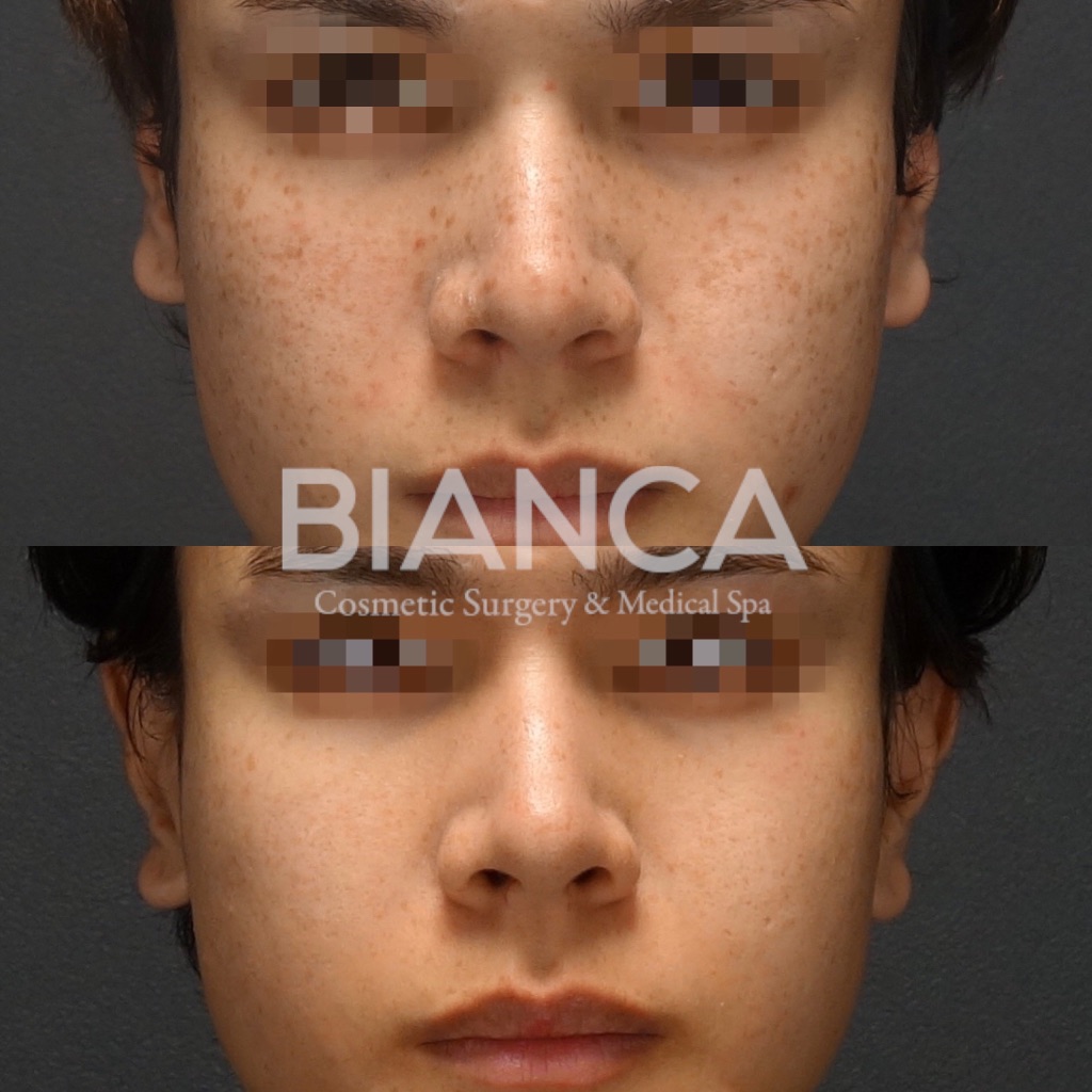 ピコトーニング（Pico Toning）