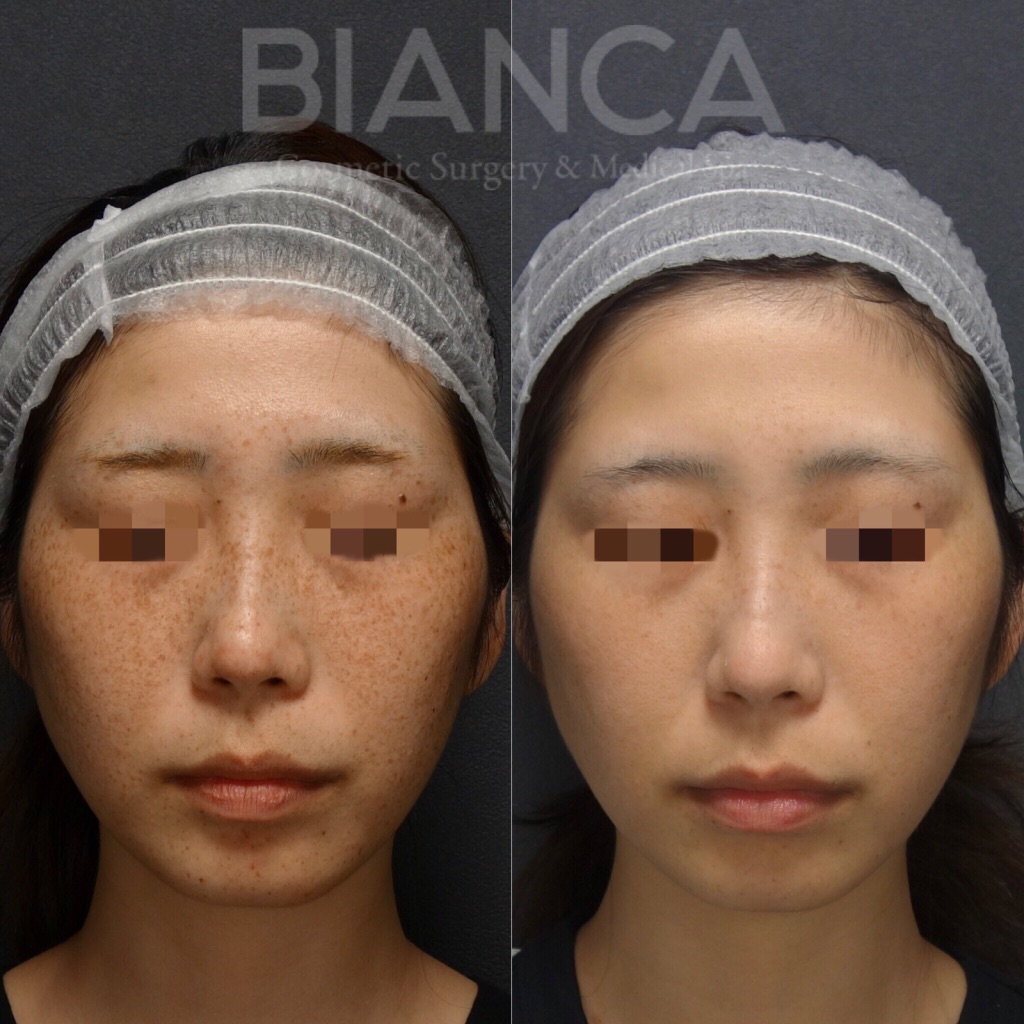 ピコトーニング（Pico Toning）