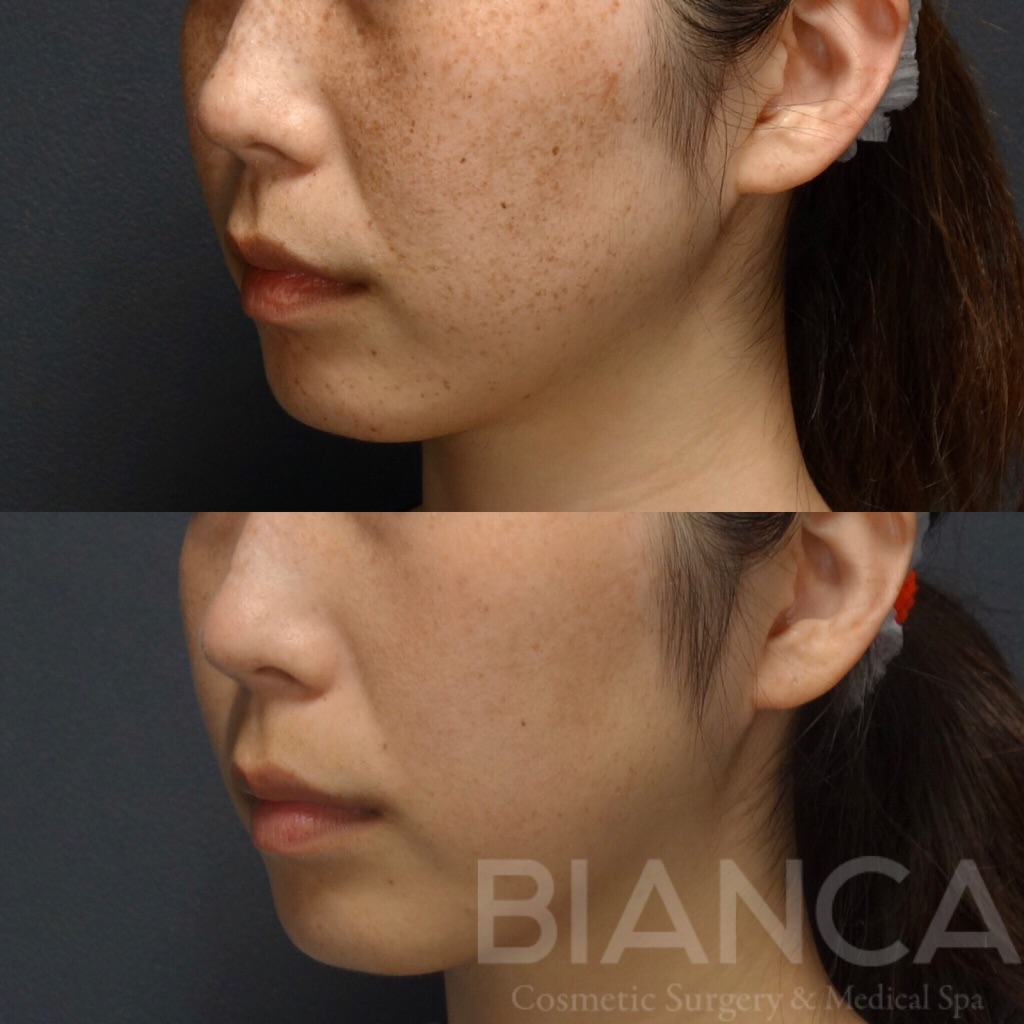 ピコトーニング（Pico Toning）