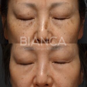 シミ取り-ピコトーニング（Pico Toning）症例