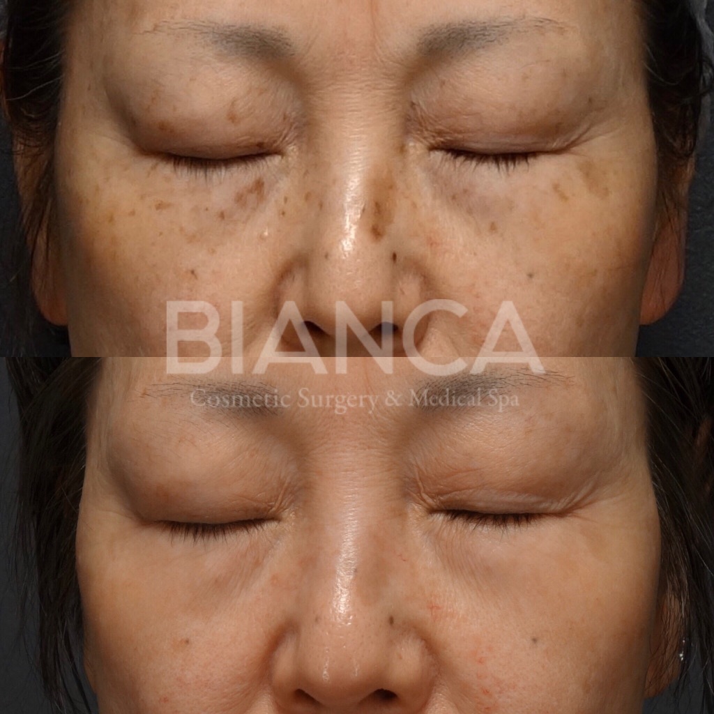 ピコトーニング（Pico Toning）