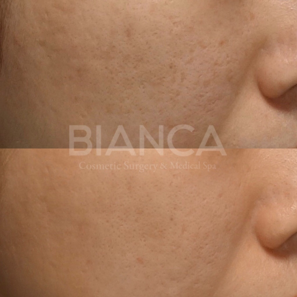 ピコフォーカス（ピコフラクショナル）