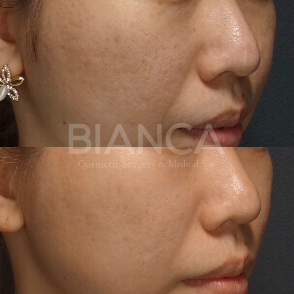 ピコフォーカス（ピコフラクショナル）