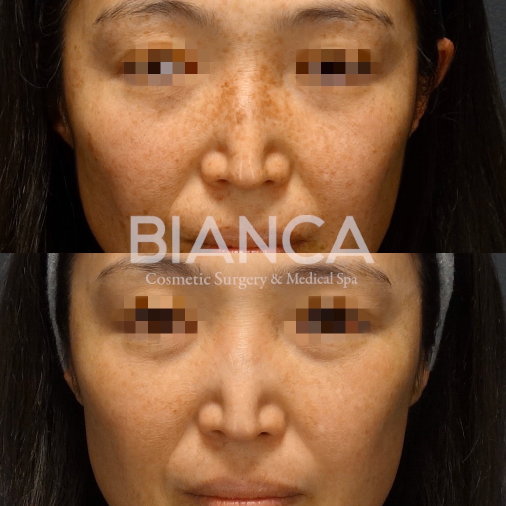 ピコスポット＋ピコトーニング