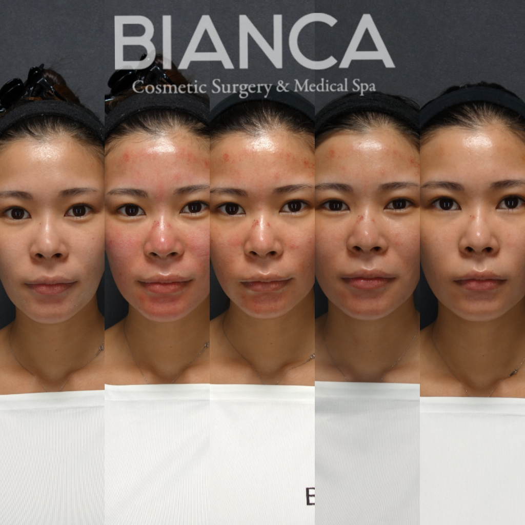 ヴァンパイアフェイシャル（vampire facial）