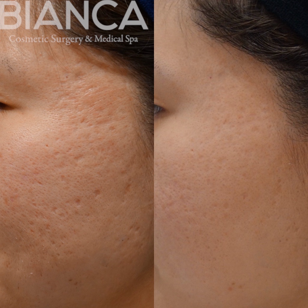 ヴァンパイアフェイシャル（vampire facial）