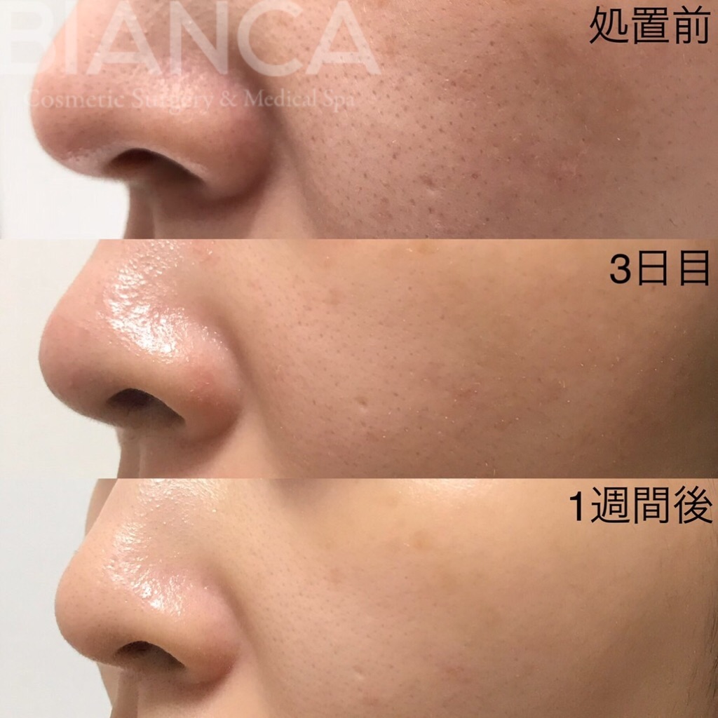 ヴァンパイアフェイシャル（vampire facial）