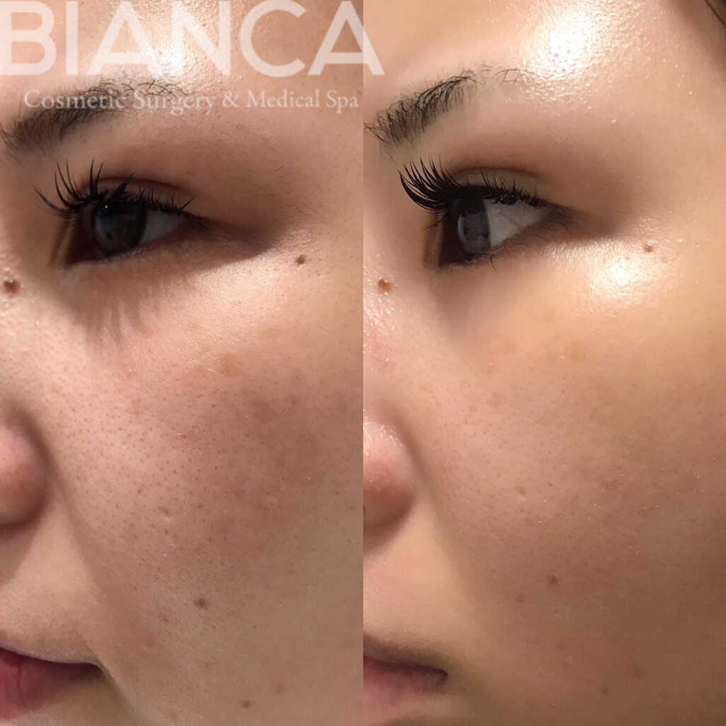 ヴァンパイアフェイシャル（vampire facial）