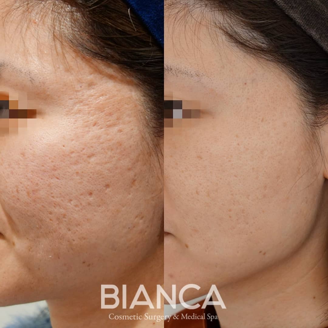 ヴァンパイアフェイシャル（vampire facial）