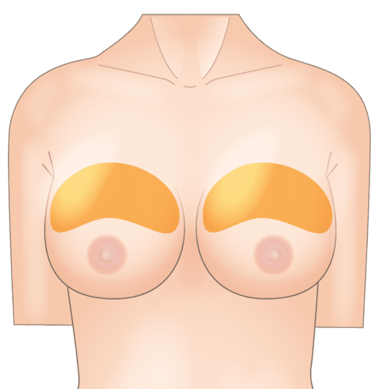  下垂や左右差といった形状のお悩みも解消