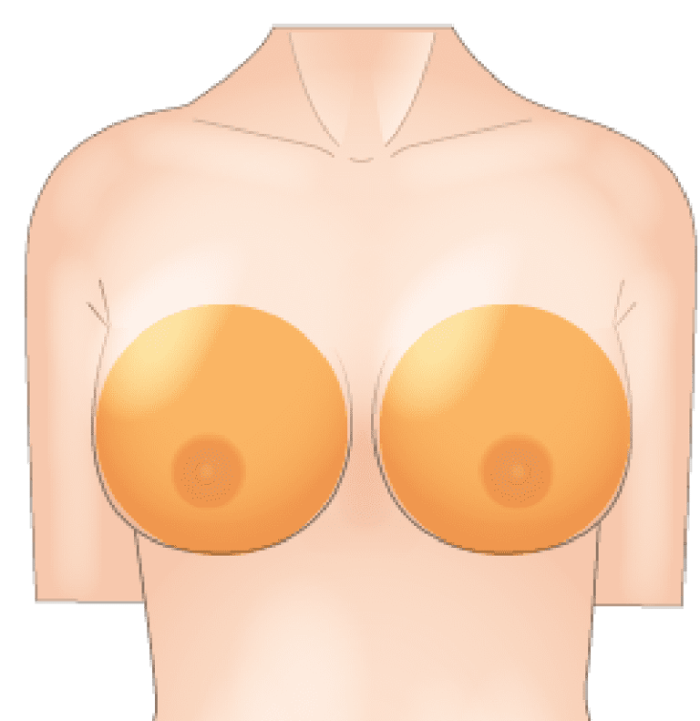  下垂や左右差といった形状のお悩みも解消