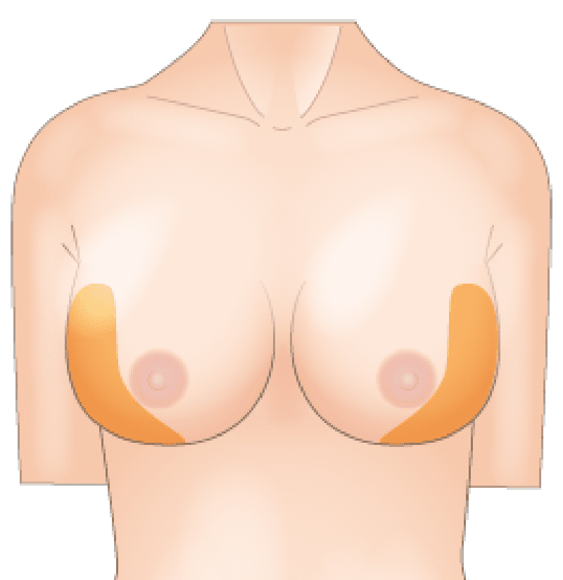  下垂や左右差といった形状のお悩みも解消