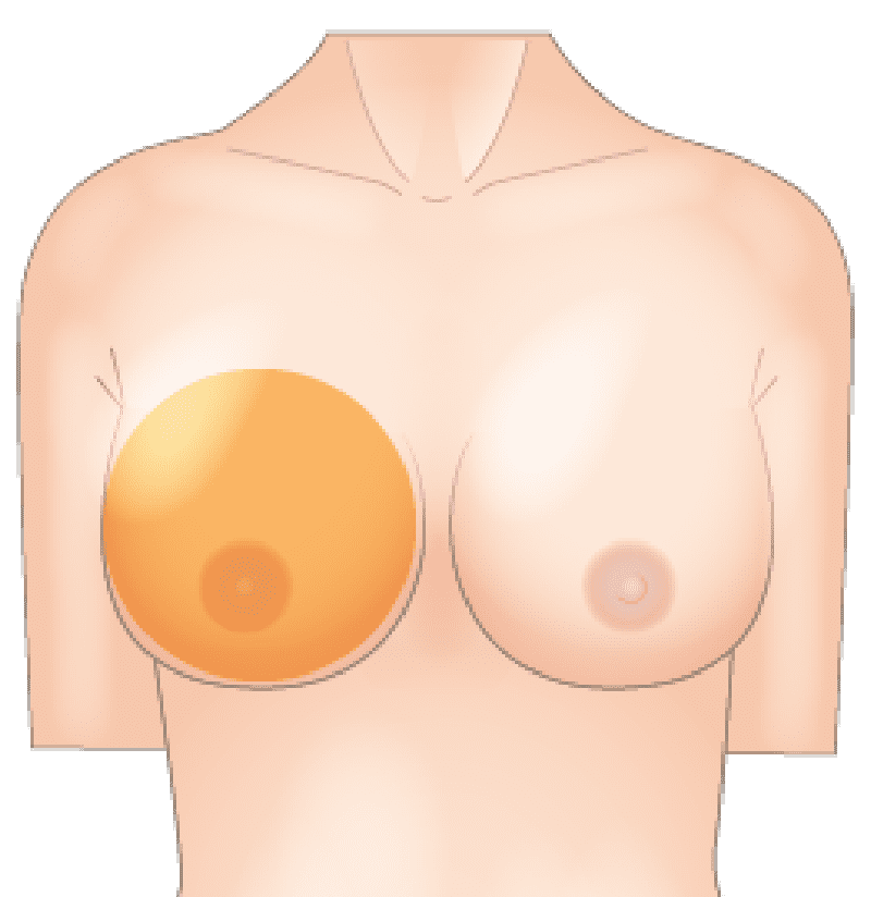  下垂や左右差といった形状のお悩みも解消