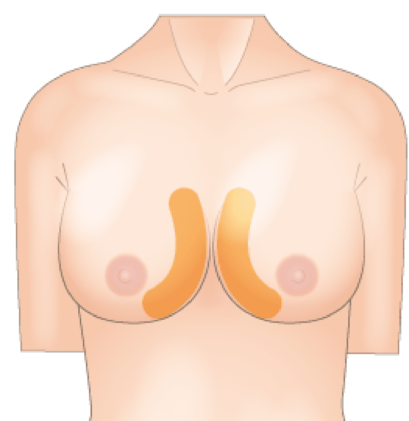  下垂や左右差といった形状のお悩みも解消