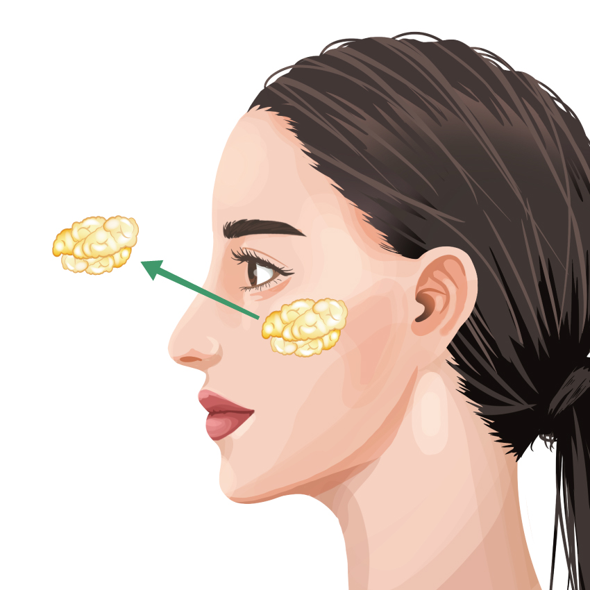 メーラーファット除去