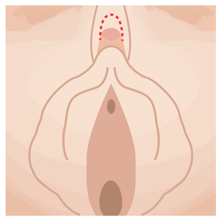 クリトリス包茎