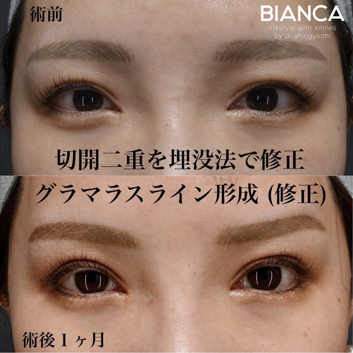 埋没法（マルチプルノット）・グラマラスライン形成（下瞼開大術）