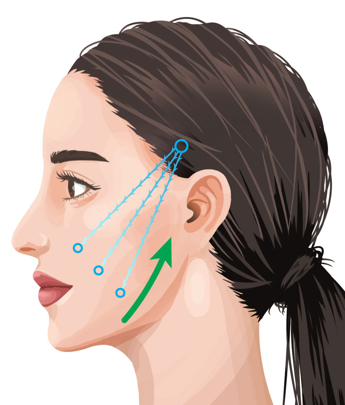BIANCA LIFT（糸リフト各種）ビアンカ銀座｜日本を代表する美容健康再生医療のクリニック