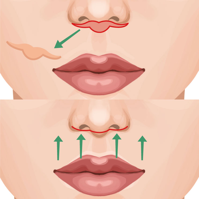 リップリフト（人中短縮）