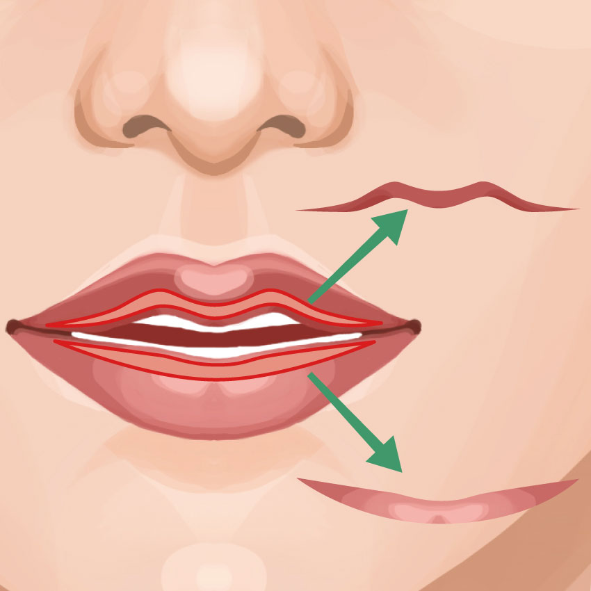 口唇縮小（たらこ唇修正）
