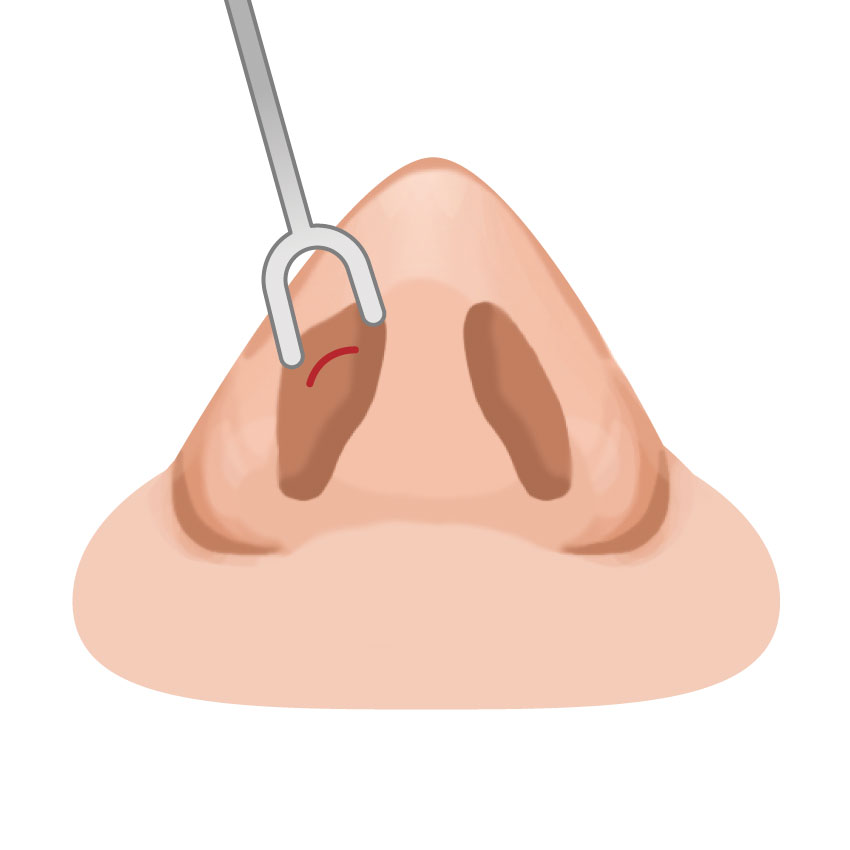 シリコンプロテーゼによる隆鼻術とは<br />