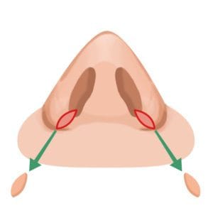 小鼻縮小手術の施術箇所イメージ