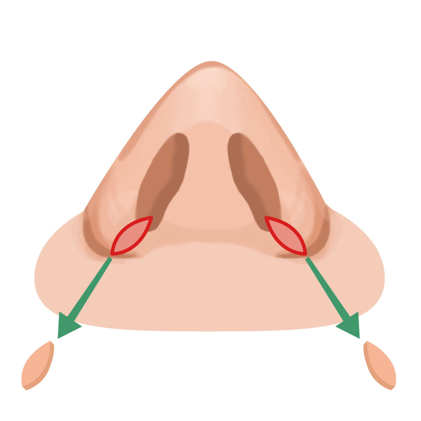 鼻翼縮小（小鼻縮小）