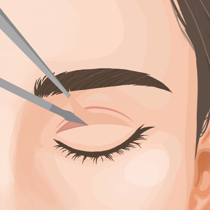 二重切開法 ビアンカ銀座｜日本を代表する美容健康再生医療のクリニック