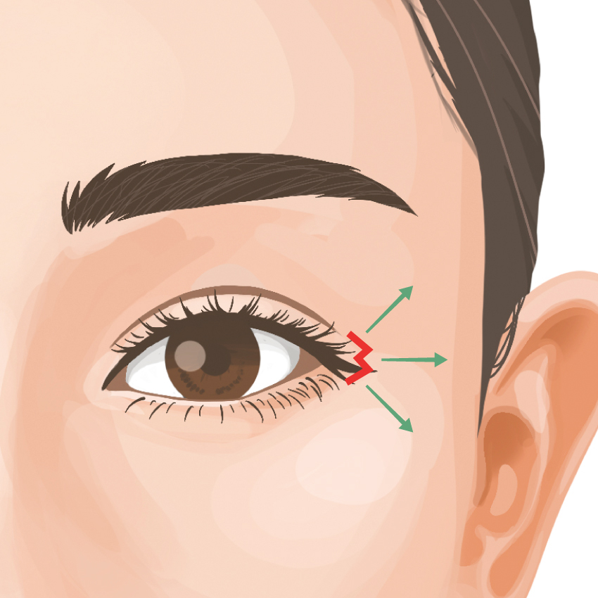 目尻切開 ビアンカ銀座｜日本を代表する美容健康再生医療のクリニック