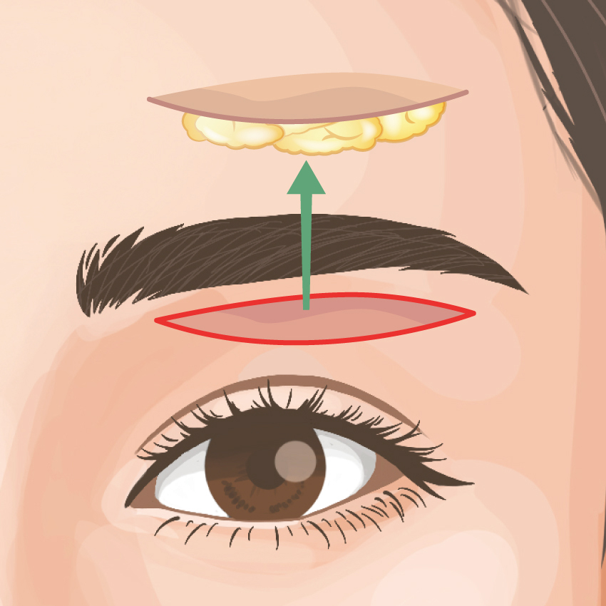 眉下リフト（眉下切開）