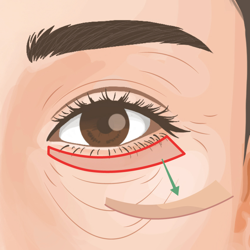 下瞼たるみ取り