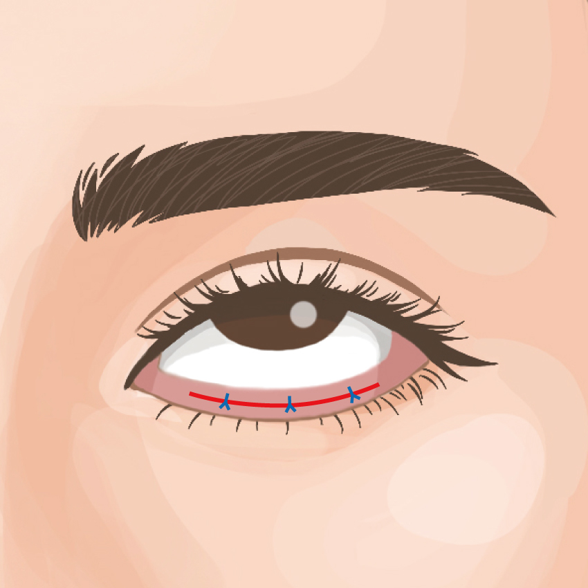 グラマラスライン形成（下瞼開大術）