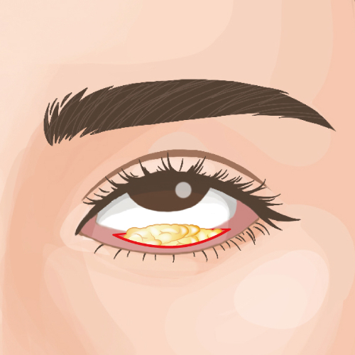 目の下クマ・たるみ取り（経結膜脱脂術）