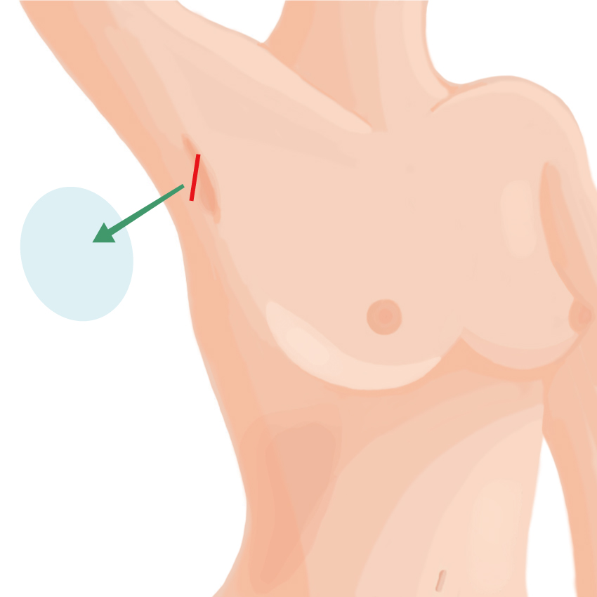 シリコンインプラント抜去も提供