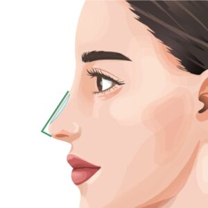 シリコンプロテーゼ(隆鼻術)銀座・表参道にあるBIANCA CLINIC ビアンカクリニック|美容外科・美容皮膚科・再生医療・美容婦人科・美容内科・医療アートメイク